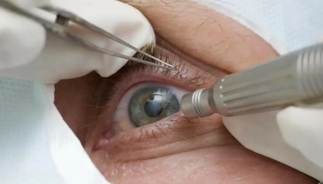 Cirurgia que muda cor dos olhos é indicada apenas para pessoas cegas Cirurgia que muda cor dos olhos é indicada apenas para pessoas cegas; entenda